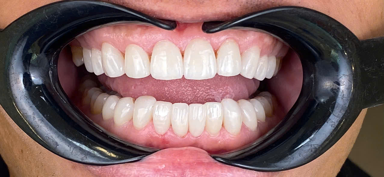 After treatment