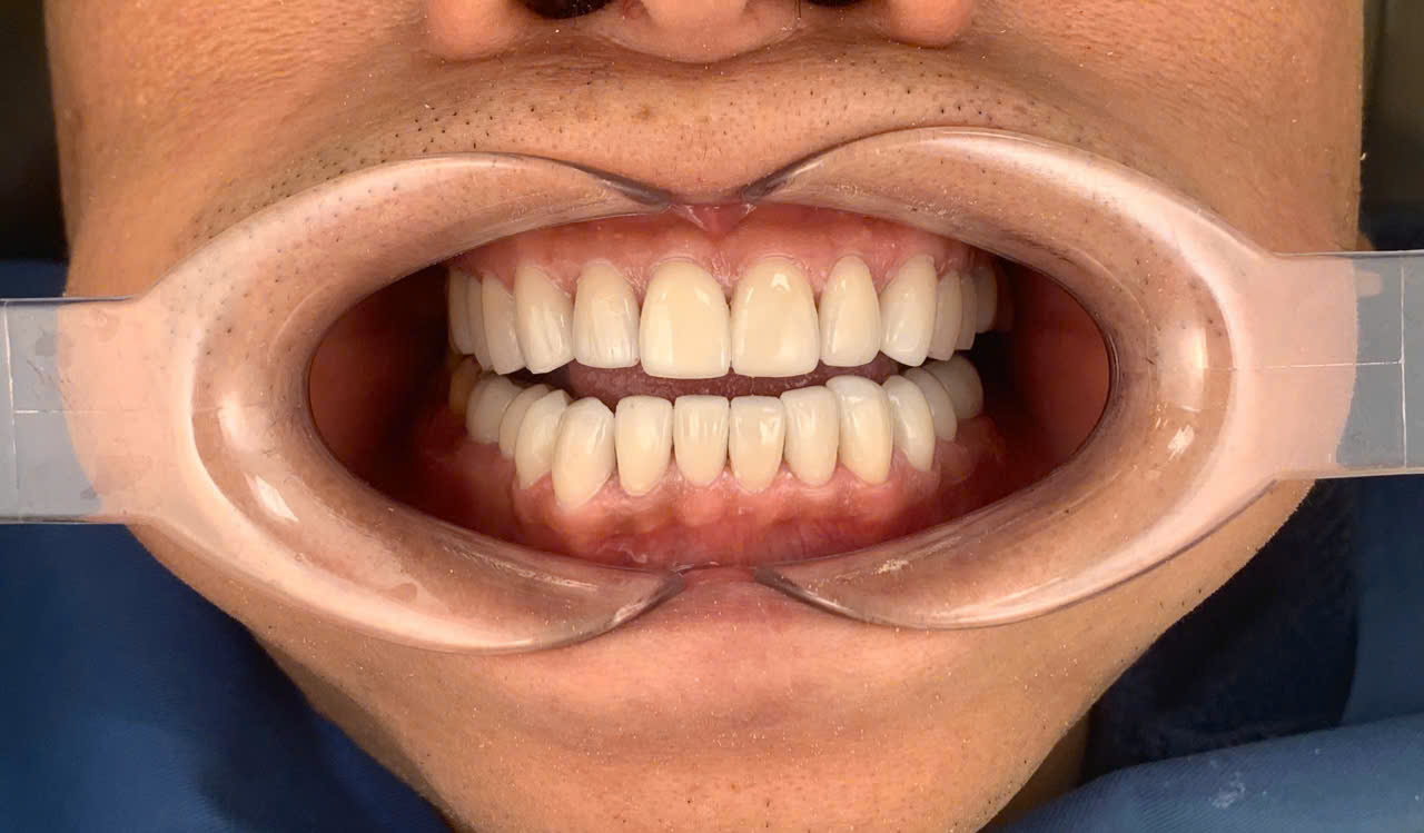 After: Old mismatched restorations