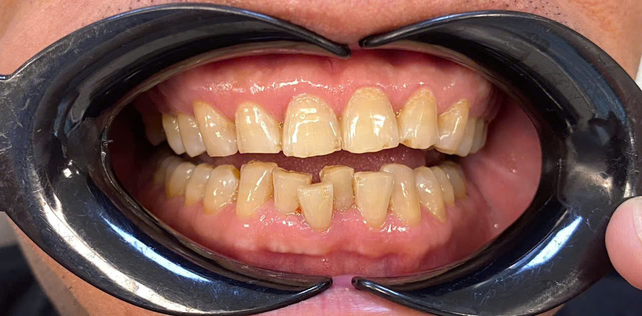 Before treatment