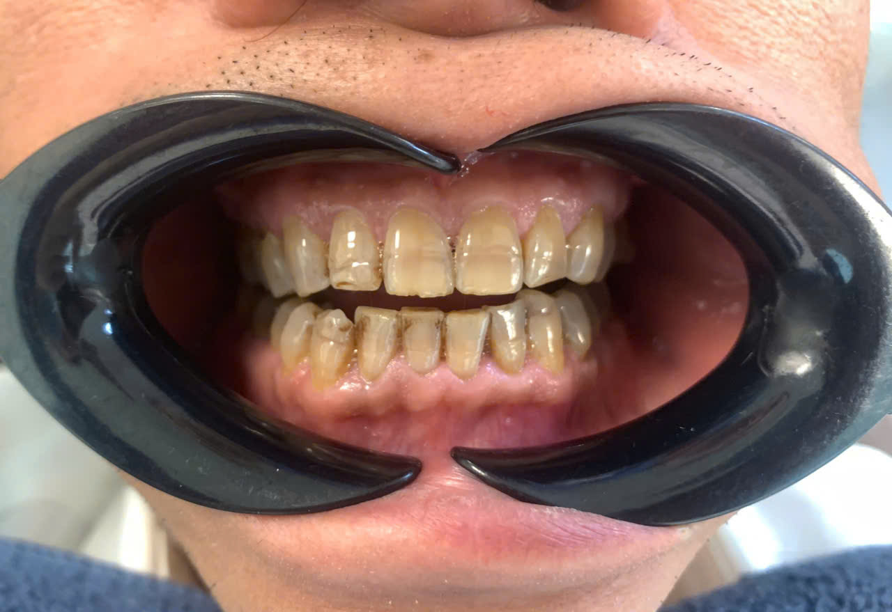 Before: Old mismatched restorations